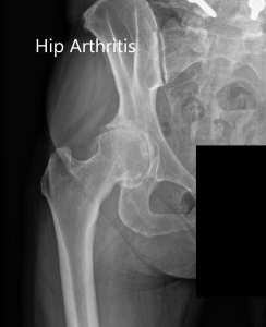 picture of x-ray image of an arthritic hip