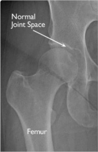 picture of x-ray image of a normal hip