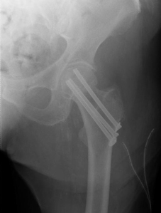 picture of x-ray image of a hip that has been repaired with 3 screws