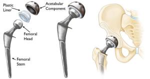 image of hip implant parts for total hip replacement