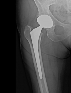 photo of typical hip implant