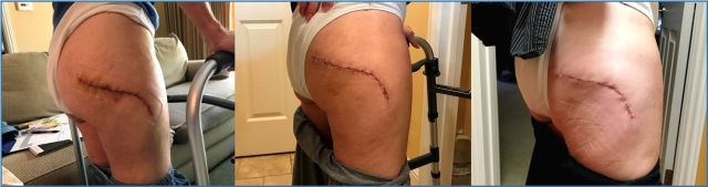 photo of my surgical incision on Day 5 (left), Day 17 (center), and Day 28 (right)